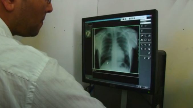 tuberculosis